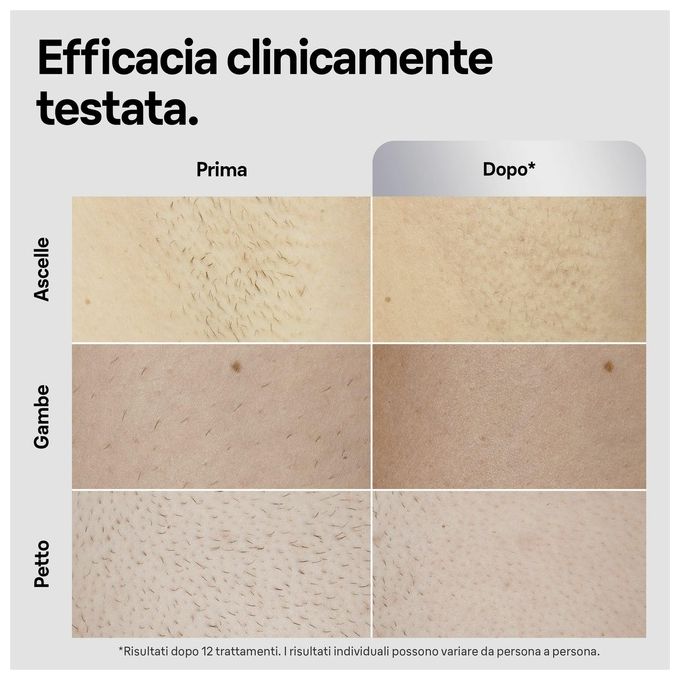 Braun 7500435238373 Silk·expert Pro 5 Epilatore a Luce Pulsata con Sensore Skin Pro 2.0 10 Livelli di Intensita' 125 Impulsi al Minuto colore Bianco